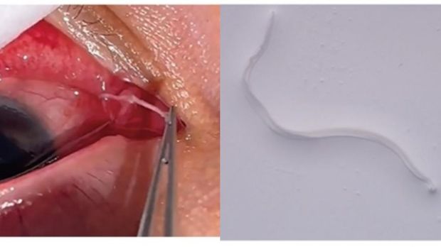 Ngeri, Ada Cacing 'Bersarang' di Mata Wanita Ini! Begini Penampakannya Seorang wanita 41 tahun di Beijing, China, mengelukan ada benda yang tersangkut di matanya yang ternyata cacing. Begini penampakannya.