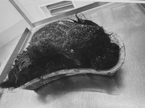 Dokter Keluarkan Gumpalan Rambut Raksasa dari Perut Bocah 14 Tahun