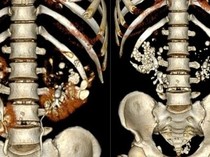 Ginjal Pria Umur 35 Dipenuhi Ratusan Batu, Kebiasaan Ini Jadi Biang Keroknya