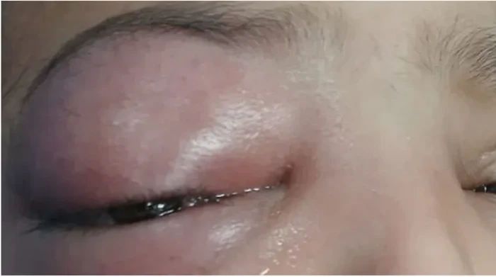 Bocah Palestina Mengeluh Sakit Mata dan Nyaris Buta, Berawal dari Sakit Gigi