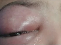 Bocah Palestina Mengeluh Sakit Mata dan Nyaris Buta, Berawal dari Sakit Gigi