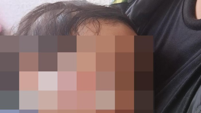 Anak 1 tahun penuh luka sepulang dari daycare di Surabaya