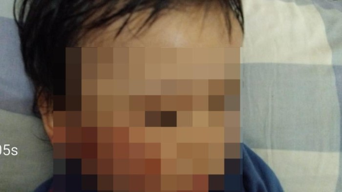 Anak 1 tahun penuh luka sepulang dari daycare di Surabaya