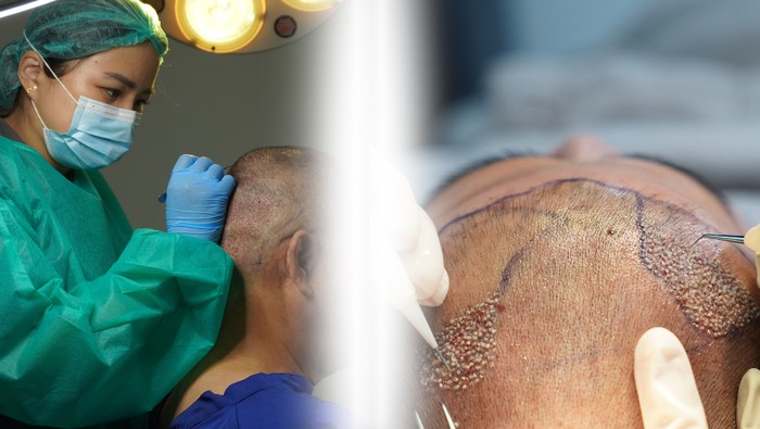 Hukum Transplantasi Rambut dalam Agama Islam, Bolehkah?