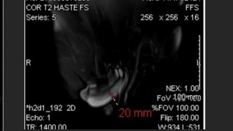 Krek! Dokter Tangani Kasus Mr P 'Patah' saat Bercinta, Berujung Jalani Operasi