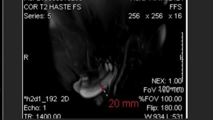 Krek! Dokter Tangani Kasus Mr P Patah saat Bercinta, Berujung Jalani Operasi