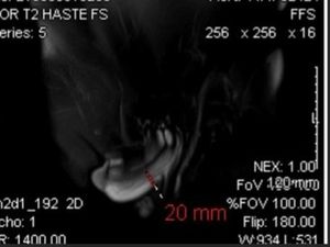 Krek! Dokter Tangani Kasus Mr P Patah saat Bercinta, Berujung Jalani Operasi