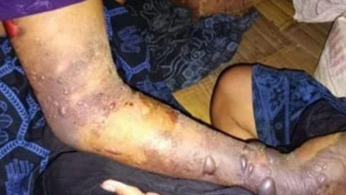 Warga Badui di pedalaman Kabupaten Lebak, Banten menjadi korban gigitan ular berbisa jenis ular tanah dan menyebabkan tangan korban menghitam. ANTARA/HO-Sahabat Relawan Indonesia