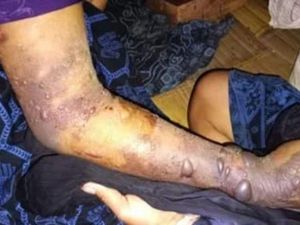 Dinkes Lebak Janji Segera Sediakan Serum Anti-bisa Ular untuk Warga Baduy