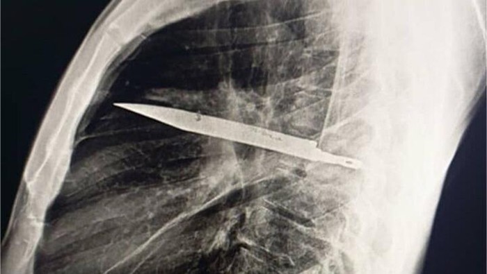 Pisau nyangkut di payudara pria