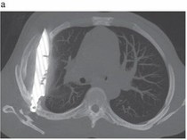 Bikin Ngilu! Pria Ini Baru Sadar Ada Pisau di Dadanya Selama 8 Tahun
