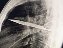 Foto-foto Penampakan Pisau Menancap di Dada, Pasien Sadar Setelah 8 Tahun