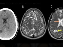 Cacing Pita Bersarang di Otak Pria gegara Doyan Makan Daging Babi Tak Matang