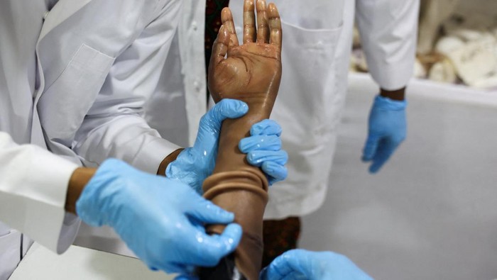 Inovasi teknologi medis kembali lahir dari Nigeria. Sebuah perusahaan prostetik di negara bagian Akwa Ibom berhasil menciptakan lengan bionik dengan tampilan mirip kulit manusia, memberikan harapan baru bagi para penyandang amputasi. REUTERS/Sodiq Adelakun