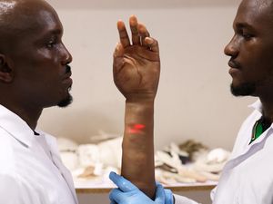 Keren, Lengan Bionik dari Nigeria Seperti Kulit Manusia