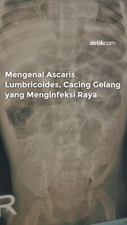 Video: Mengenal Ascaris Lumbricoides, Cacing Gelang yang Menginfeksi Raya