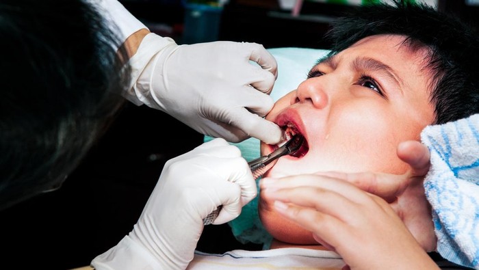 Karies Gigi pada Anak di Atas 90 Persen, IDGAI Soroti Kebiasaan Ini