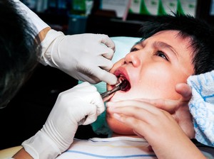 Karies Gigi pada Anak di Atas 90 Persen, IDGAI Soroti Kebiasaan Ini