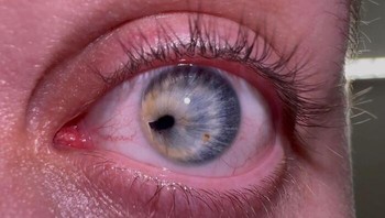 Kondisi pupil tidak berada di tengah mata atau dikenal dengan sebutan corectopia. Orang ini mengaku masih bisa melihat sama jelasnya dengan mata satunya. Foto: krisztian111996 via Bored Panda