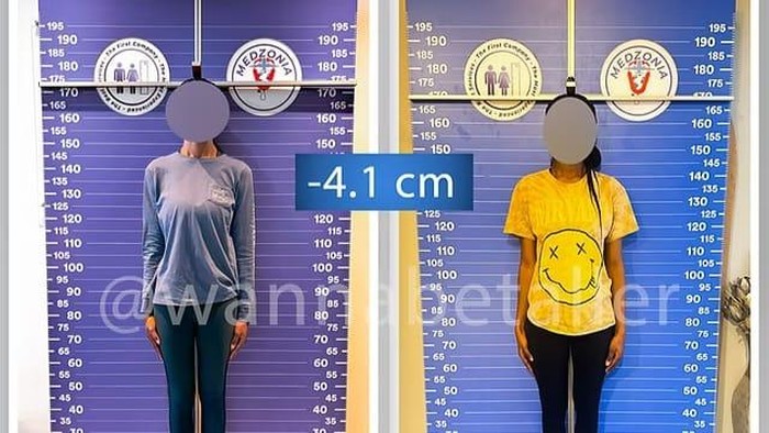 Muncul Tren Operasi Potong Tulang Kaki di Turki Agar Tubuh Terlihat Pendek