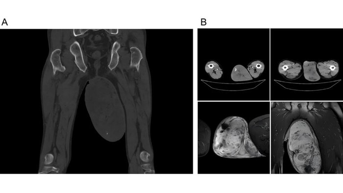Penampakan Tumor di Buah Zakar Sebesar Telur Ayam, Inikah Pemicunya?
