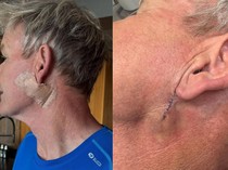 Video: Soal Operasi Karsinoma Sel Basal yang Dijalani Chef Gordon Ramsay