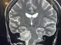 Kisah Wanita Idap Tumor Otak di Usia 20-an, Ukurannya Sudah Sebesar Alpukat