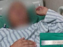 Gegara Makan Empedu Ular Mentah, Cacing Bersarang di Otak Pria Ini