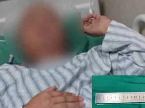 Gegara Makan Empedu Ular Mentah, Cacing Bersarang di Otak Pria Ini