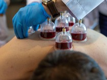 6 Manfaat Bekam untuk Kesehatan dan Efek Sampingnya, Kapan Bekasnya Hilang?