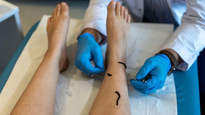 Dr. Erdal Dilekci, a specialist in physical medicine and rehabilitation at Medicana International Hospital, performs leech threapy on Seyda Yilmaz in Istanbul, Turkey August 28, 2025. Known locally as hacamat, wet cupping and other traditional treatments such as leech therapy are being increasingly performed under government oversight in Turkey, rather than in informal settings such as homes, to complement modern medicine and cut down infection risks. REUTERS/Umit Bektas