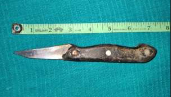 Ngilu! Dokter Temukan Pisau 17 Cm di Usus Pasien, Ternyata Ini Awal Mulanya