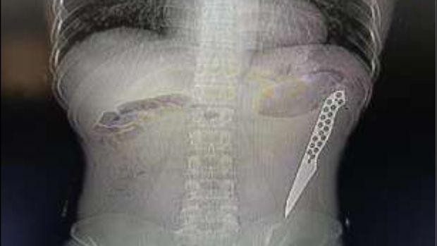 Pisau tertanam di tubuh pasien.