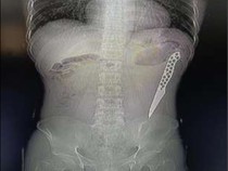 Ngeri! Pisau 17 Cm Bersarang di Usus Pria Ini 8 Bulan