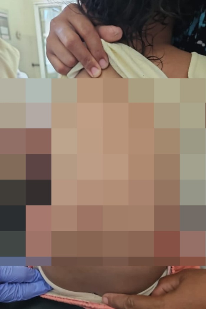 Anak 5 tahun di Pasuruan diserang monyet liar
