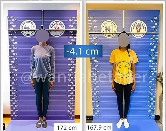 Operasi pemendekan kaki diminati di Turki.