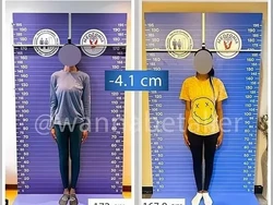 Operasi Pemendekan Kaki Populer di Turki, Demi Terlihat Lebih Mungil