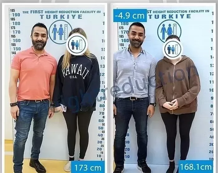 Operasi pemendekan kaki diminati di Turki.