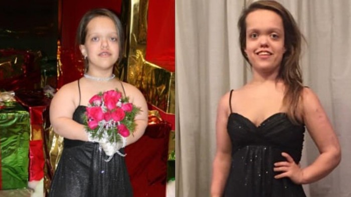 Transformasi Wanita AS usai Operasi Peninggi Badan, dari 117 Cm Jadi 151 Cm