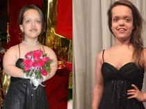 Transformasi Wanita AS usai Operasi Peninggi Badan, dari 117 Cm Jadi 151 Cm