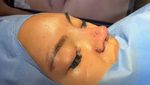 Shafa Harris Jalani Operasi Hidung Lagi