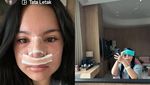 Shafa Harris Jalani Operasi Hidung Lagi