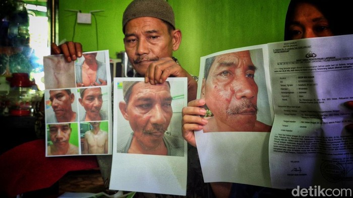 Cecep korban kekerasan yang diduga dilakukan oknum ASN di Kecamatan Pabuaran, Kabupaten Sukabumi. (Syahdan Alamsyah/detikJabar)