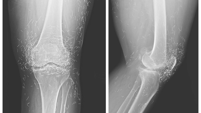 Dokter Temukan Ratusan Benang Susuk Emas di Lutut Pasien, Ketahuan Lewat Rontgen