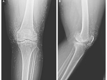 Dokter Temukan Ratusan Benang Susuk Emas di Lutut Pasien, Ketahuan Lewat Rontgen