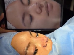 Penampilan Terbaru Shafa Harris Usai Kembali Oplas, Wajah Bengkak & Diperban