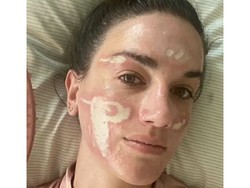 Wajah Wanita Ini Rusak Permanen Setelah Perawatan di Klinik Langganan Artis