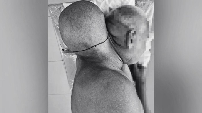 Cerita Pria Punya Tumor Raksasa Sebesar Kepala, Tolak ke RS Selama 16 Tahun