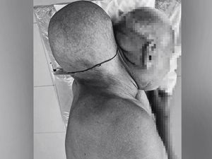 Cerita Pria Punya Tumor Raksasa Sebesar Kepala, Tolak ke RS Selama 16 Tahun