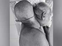 Pria 65 Tahun Punya Tumor Sebesar Kepala, Sempat Percaya Bisa Sembuh Sendiri